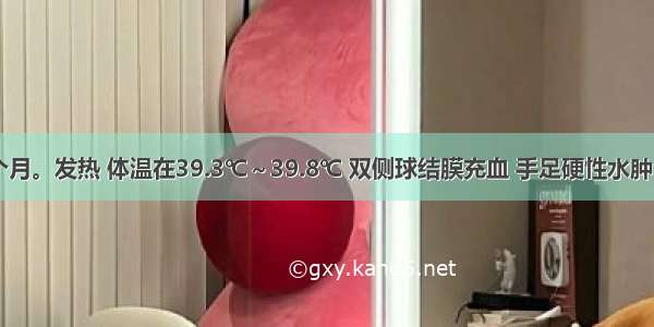 患儿 18个月。发热 体温在39.3℃～39.8℃ 双侧球结膜充血 手足硬性水肿 颈部淋巴