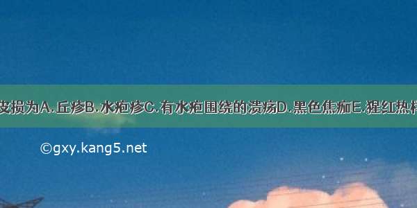 炭疽特征性的皮损为A.丘疹B.水疱疹C.有水疱围绕的溃疡D.黑色焦痂E.猩红热样皮疹ABCDE