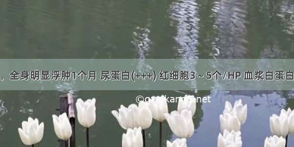 患儿 4岁。全身明显浮肿1个月 尿蛋白(+++) 红细胞3～5个/HP 血浆白蛋白229/L 血