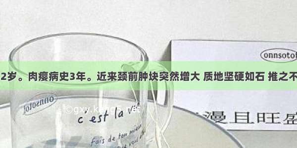 患者 女 52岁。肉瘿病史3年。近来颈前肿块突然增大 质地坚硬如石 推之不动。应首